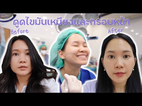 รีวิว ดูดไขมันเหนียง ลดแก้มห้อย ปังมาก! | Minimayy