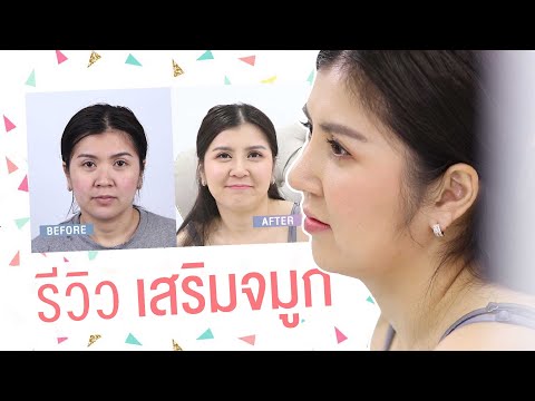 ศัลยกรรมเสริมจมูก หลังทำ 3 สัปดาห์ ธีรพรคลินิก หมอชลธิศ